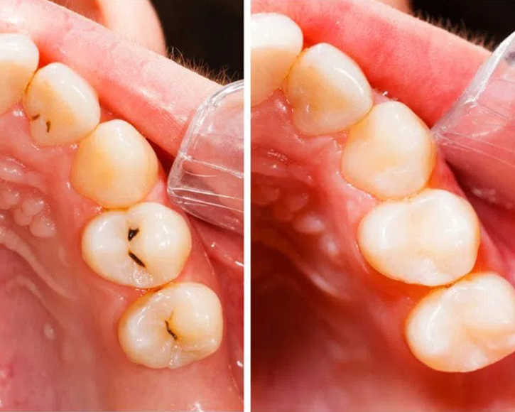 Dental Fillings in San Jose, CA - Before and After Treatment