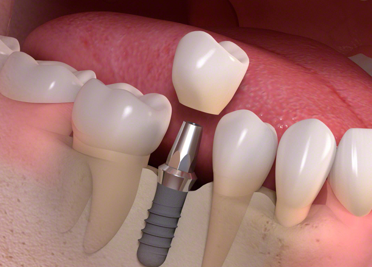 Dental Implant Surgery in San Jose, CA
