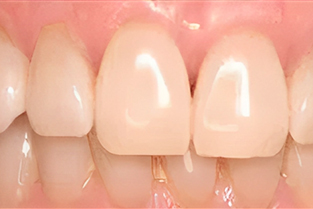 Gum Grafting in San Jose, CA - After Treatment