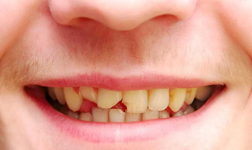 Cracked or Chipped Tooth - Urgent Dental Care Sign