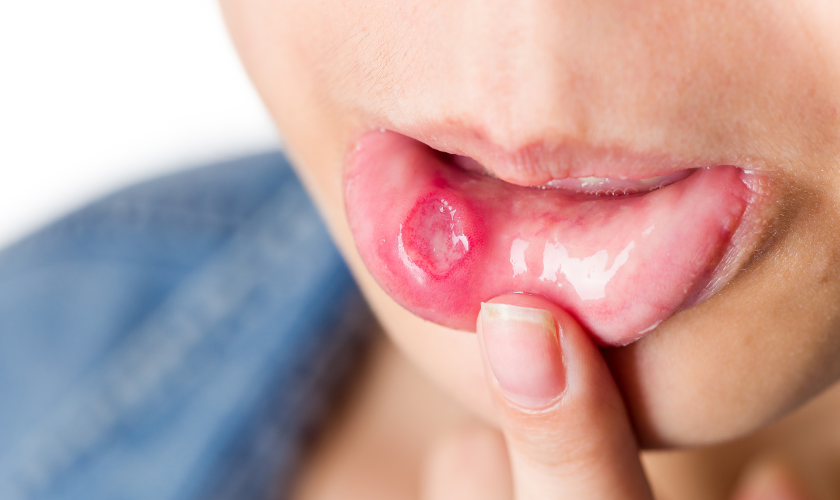 Persistent Oral Sores - Urgent Dental Care Sign