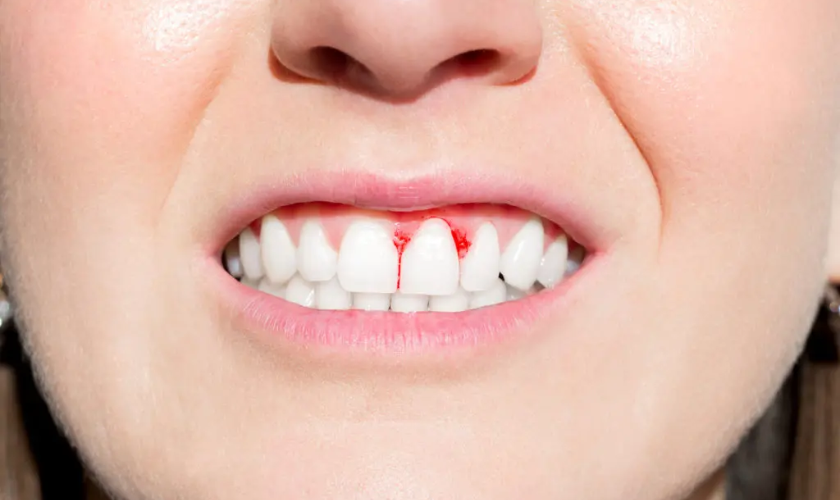 Swollen or Bleeding Gums - dental emergency
