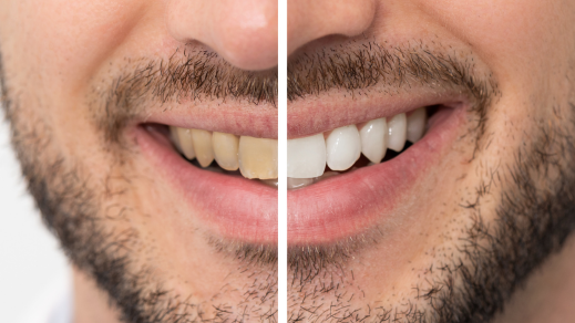 From Dull To Dazzling: Professional Teeth Whitening Tips For A Memorable Valentine’s Day