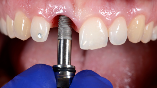 Dental Implant Surgery for Seniors: What Makes It an Ideal Solution?